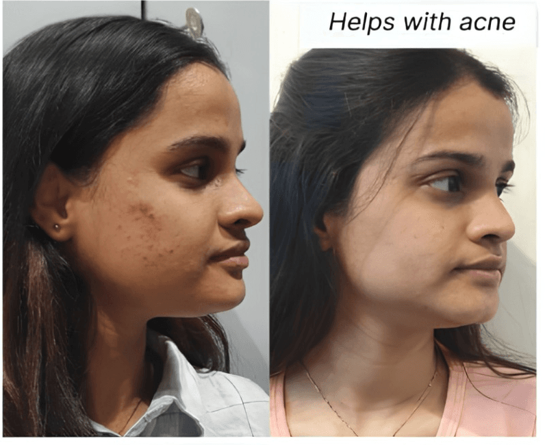 Helps with acne-prone skin