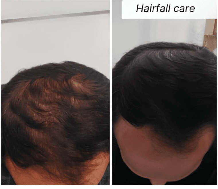 Hairfall care support